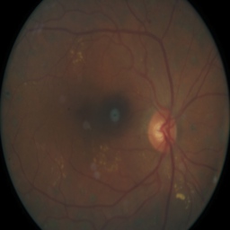 Diseased eye image